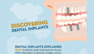 cost of dental implants