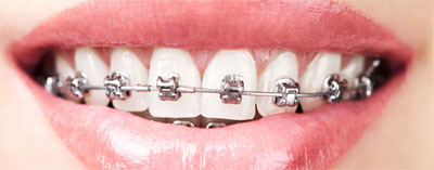 Orthodontist Glendale