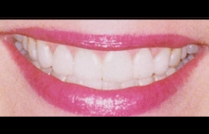 Teeth Whitening Glendale After