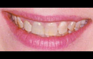 Teeth Whitening Glendale Before