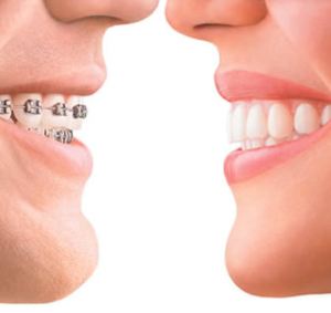 invisalign braces vs traditional braces