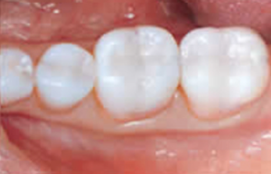 White Fillings Glendale - Smile Makeover of LA