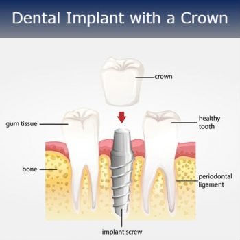 Dentist Glendale Dental Implant Crown Types - Smile Makeover of LA