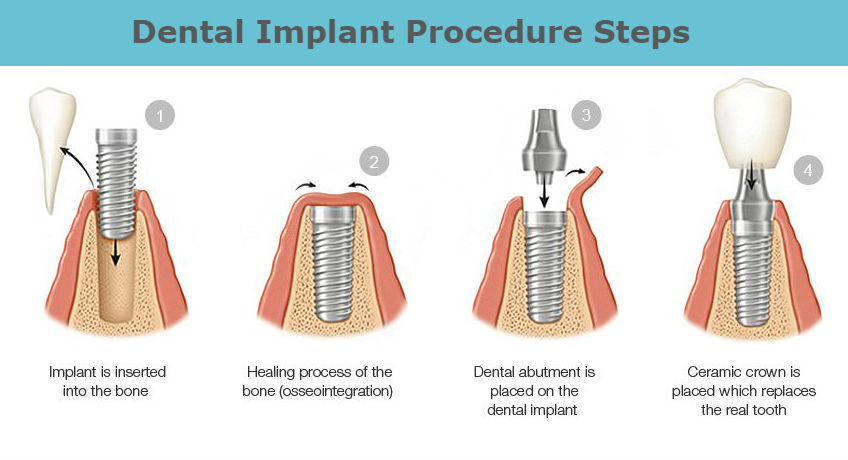Dental Implant Steps