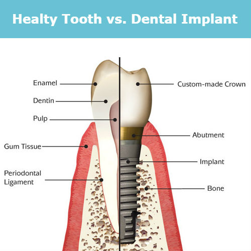 Healthy Tooth vs Implant Tooth