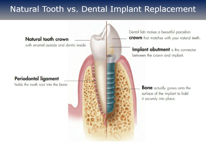 Natural Tooth vs. Dental Implants