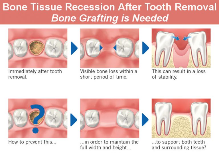 Dentist Glendale: Bone Grafting Types, How and Why Is It Done - Smile ...