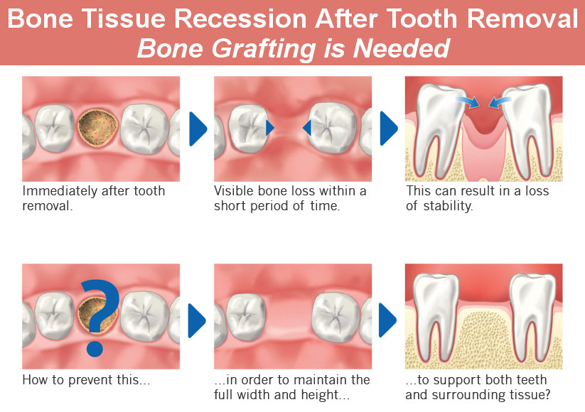 Dentist Glendale Bone Grafting Types How And Why Is It Done Smile Makeover Of La