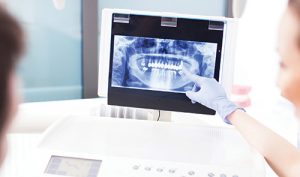 Digital Dental X-Ray Explained