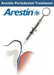Arestin Periodontal Treatment