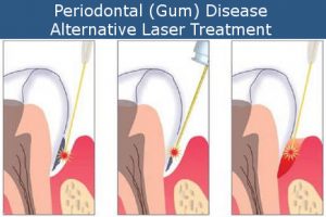 Periodontal Laser Treatment Steps