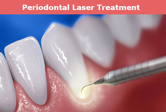 Periodontal Laser Treatmenr