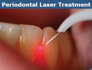 Advantages of Periodontal Laser Treatment