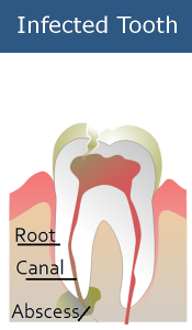 Infected Tooth Needs Root Canal Treatment