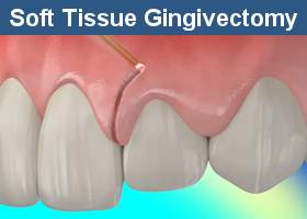 What Is Gingivectomy