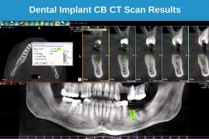 CB Ct Scan Result