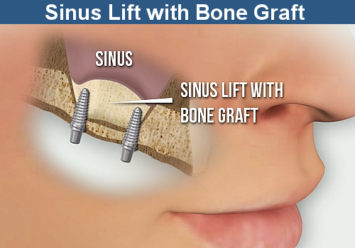 The Sinus Lift with Bone Graft