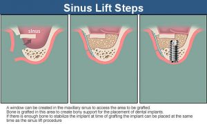 The Sinus Lift Steps