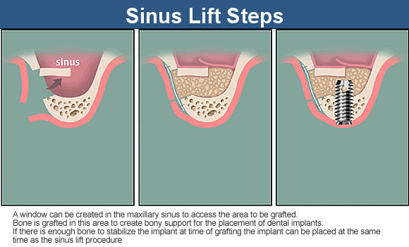 The Sinus Lift Steps