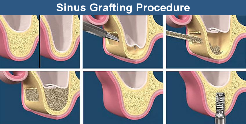 Sinus Lift Graft Procedure