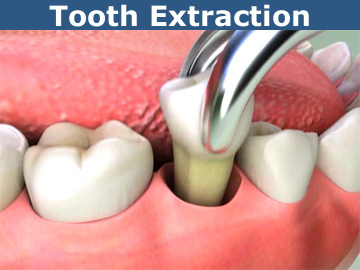 surgical tooth removal - extraction
