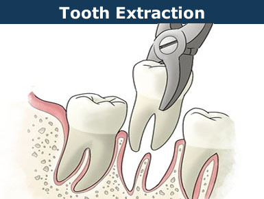 simple tooth removal - extraction