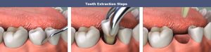 Tooth extraction steps