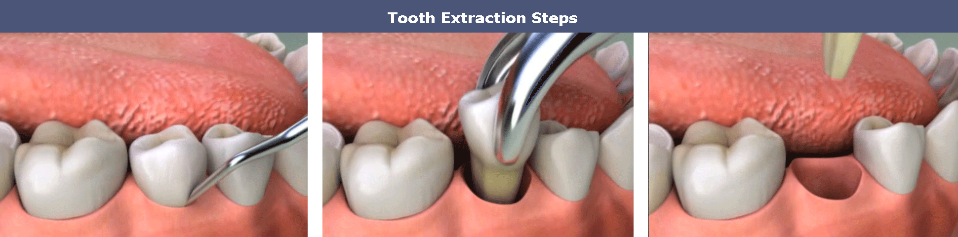 Tooth extraction steps