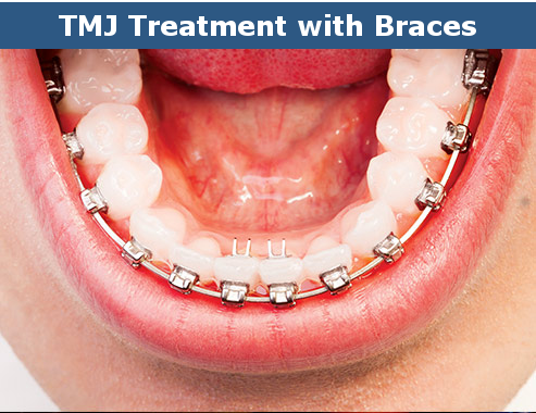 TMJ braces