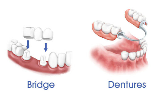 bridges dentures