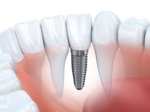 dental implant between teeth