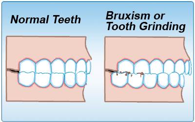 teeth grinding bruxism