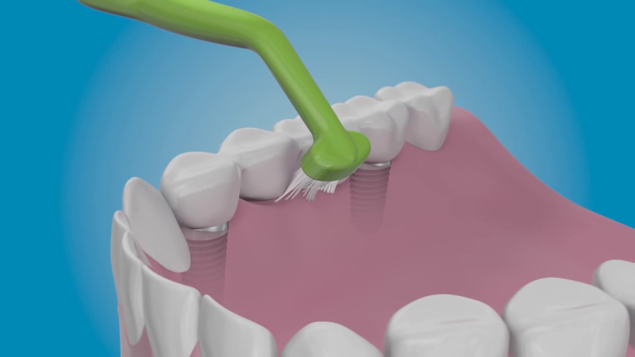 Care for Dental Implants
