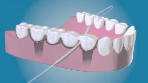 Dental implants care