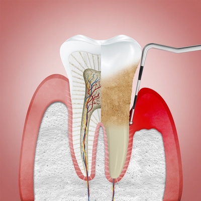 treatment for sore gums