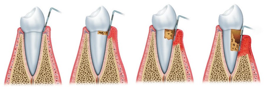 tooth mobility