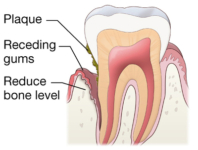 gum disease