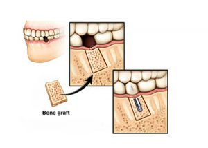 bone grafting