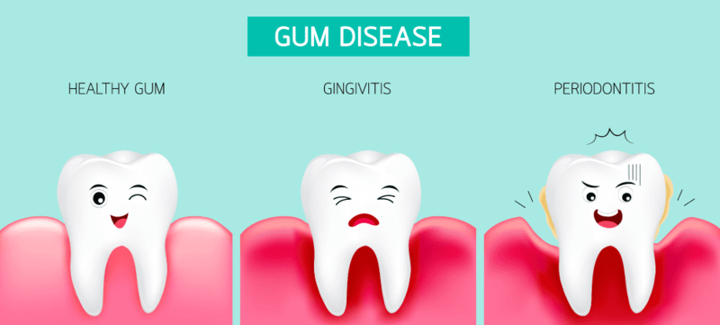 periodontitis