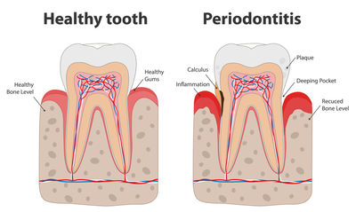 periodontitis