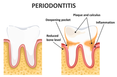 periodontitis