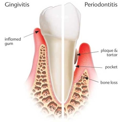 periodontitis