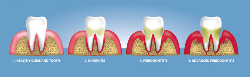 periodontitis