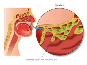 sinus infection