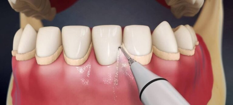 How Often Should You Get Teeth Scaling Done? - Smile Makeover of LA