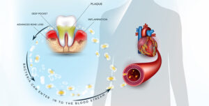 tooth abscess cause a sinus infection