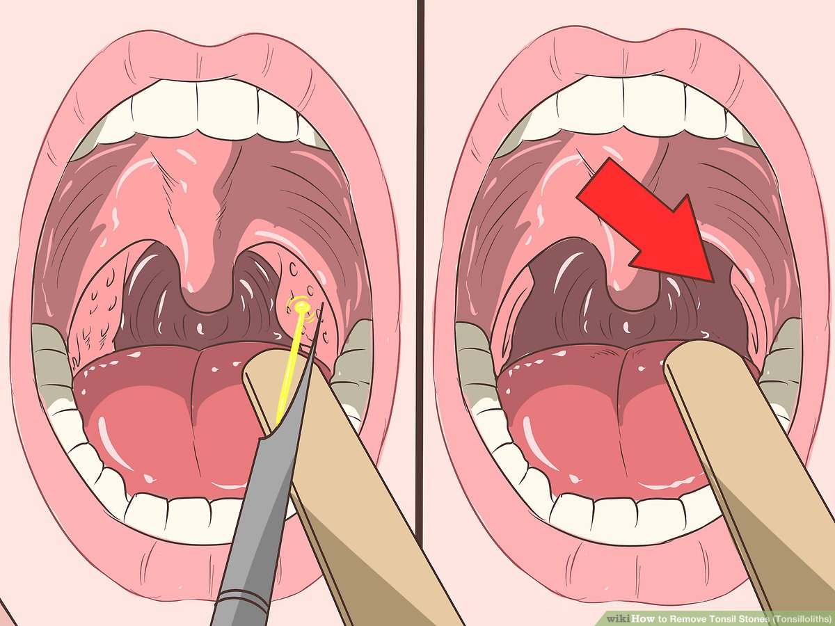 Aid1351224 V4 1200px Remove Tonsil Stones Tonsilloliths Step 17