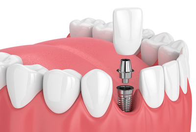 dental implant