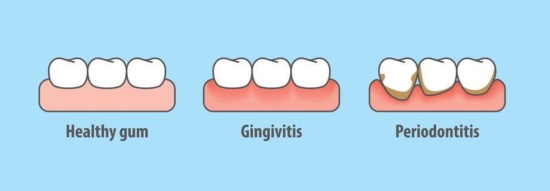 infected gums