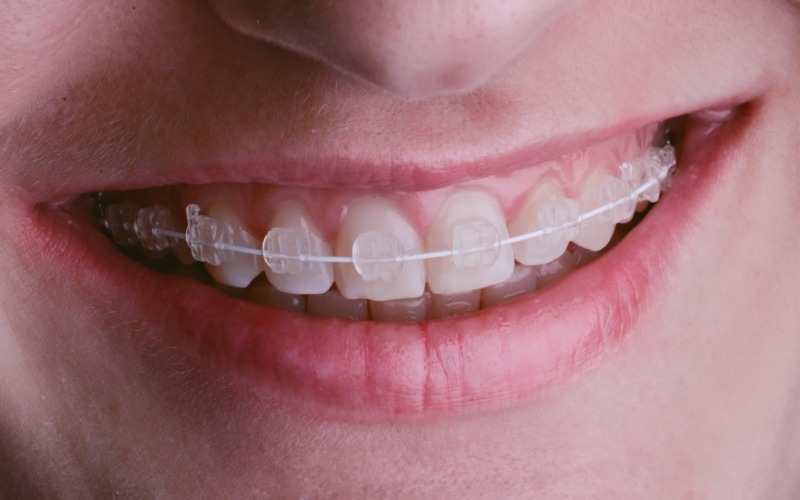 getting braces after 50